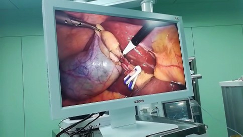 內(nèi)窺鏡手術(shù)攝像系統(tǒng)